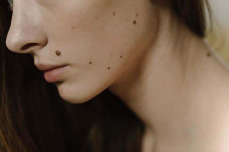 taches au visage